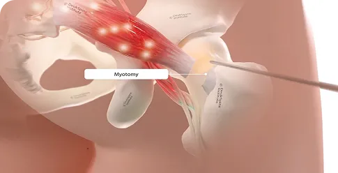 Illustration of a myotomy procedure on pelvic muscles.