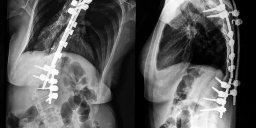 Scoliosis-w-Fusion